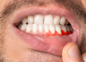 בעיית חניכיים